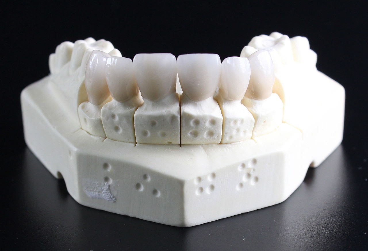 dentures cast